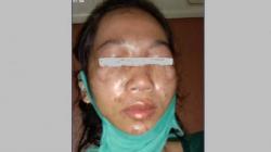 Guru TK Cantik di OKU Timur Disiram Cuka Para, Wajah Rusak dan Mata Buta<