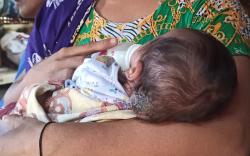 Bayi Penderita Tumor Otak di Puncak Jeringo Lotim Akhirnya Dapat Bantuan