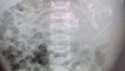 Langka, Bayi Perempuan Ini Lahir dalam Kondisi Ada Janin Kembar di Perutnya