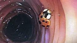 Merinding, Seekor Kepik Hidup dan Merangkak di Usus Pasien 