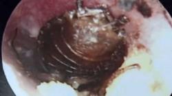 Kecoak Masuk Kuping Bocah Perempuan Ini, Bergerak ke Gendang Telinga