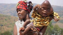 Malang, Bayi Terlahir Cacat Kepala Berbentuk Segitiga 