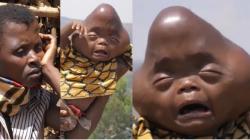 Kisah Sedih Bayi Terlahir Cacat dengan Kepala Berbentuk Segitiga