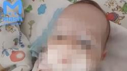 Miris, Bayi 2 Bulan Meninggal setelah Jarum Tertinggal di Paru-Paru Pasca-Operasi