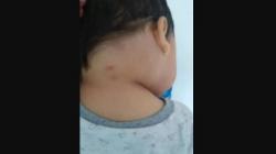 Sedih, Balita 2 Tahun Meninggal karena Gigitan Makhluk Misterius