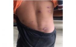 Warga Kumai Kobar Diserang Penyakit Gatal hingga Bernanah, Diduga Scabies