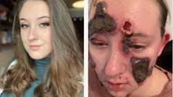 Derita Penyakit Aneh, Muka Remaja Putri Ini Penuh Koreng dan Nanah 