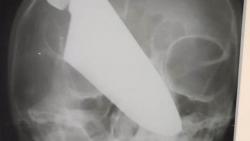 Ajaib, Wanita Ini Selamat Meski Kepala Ditusuk Pisau