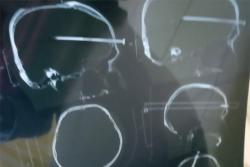 Depresi Diceraikan Istri, Pria Gunungkidul Tancapkan Paku 14 Cm ke Dahi Sendiri