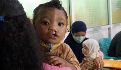 Operasi Bibir Sumbing Gratis di Kota Sorong