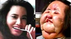  Merinding Deretan Artis Gagal Operasi Plastik, Nomor 4  Ingin Awet Muda Malah Terancam Kena Kanker 