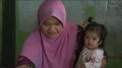 Sedih, Seorang Balita di Grobogan Kulitnya Melepuh Sejak Lahir <