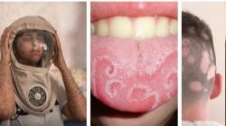 5 Penyakit Teraneh di Dunia, Ada yang Bikin Manusia Jadi Kayak Vampir