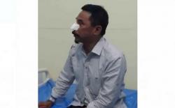 Sehan Landjar Mantan Bupati Boltim Jadi Korban Penganiayaan, Hidung Digigit sampai Putus