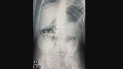 Duh, 2 Bocah Tak Sengaja Telan Logam yang Tersembunyi dalam Kue Ulang Tahun