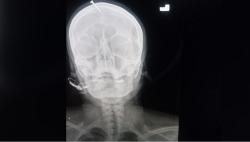 Kepala Ibu Hamil Ini Ditancapkan Paku oleh Dukun, Alasannya Tak Masuk Akal