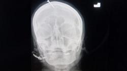  Ngeri, Dukun Ini Paku Kepala Seorang Ibu Hamil agar Bisa Punya Anak Laki-Laki 