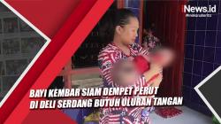 Bayi Kembar Siam Dempet Perut di Deli Serdang Butuh Uluran Tangan