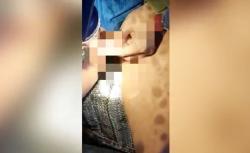 Kocak, Pemuda Blitar Ini Pasang Tindik Gembok di Kemaluan tapi Lupa Simpan Kuncinya