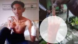 Remaja di Majalengka Dikeroyok 8 Orang, Tangan Kiri Putus Ditebas Golok<