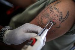 Layanan Hapus Tato Gratis di Jakarta Barat