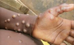 Usai Inggris dan Spanyol, Portugal Juga Temukan Kasus Orang Terinfeksi Cacar Monyet