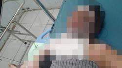 Istri yang Dibakar Suami di Bangka Masuk ICU, Wajah Rusak hingga Sulit Bernafas