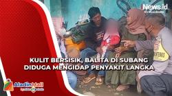 Kulit Bersisik, Balita di Subang Diduga Mengidap Penyakit Langka
