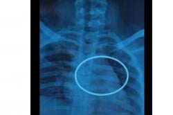 Gara-Gara Bersin, Siswi Kelas 5 SD Ini Tak Sengaja Telan Jarum saat Hendak Pakai Jilbab