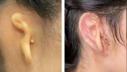 Pertama di Dunia, Perempuan Muda Ini Gunakan Telinga Hasil Print 3 Dimensi