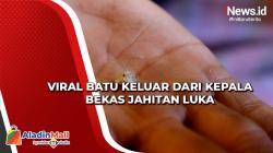 Video Viral Batu keluar dari Kepala Bekas Jahitan Luka