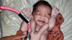 Bayi Langka Lahir dengan 4 Lengan dan 4 Kaki, Dianggap Titisan Dewi Lakshmi