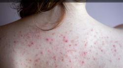 4 Penyebab Punggung Jerawatan, Bisa karena Hormon atau Keturunan