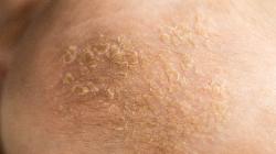 Ini Cara Mengobati Jamur Kulit yang Membandel, Jangan Panik!