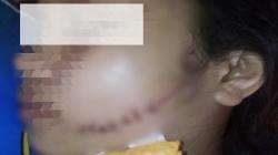 Pipi Kiri Remaja Putri di Indramayu Robek akibat Dianiaya Teman, Diduga gegara Berebut Pacar<