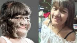 Supatra Sasuphan, Gadis Berbulu Lebat bak Serigala yang Kini Telah Menikah 