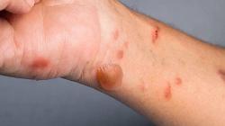 India Dilanda Penyakit Baru, 82 ​​Anak Terpapar Flu Tomat