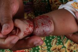 Peneliti UGM Temukan Formula Gel untuk Terapi Penyembuhan Tumor Darah