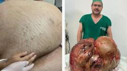 Menakutkan, Pasien Perempuan Idap Tumor Dalam Perut Seberat 45 Kg
