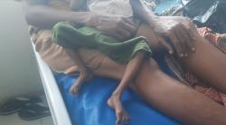 Terhimpit Ekonomi, Balita Gizi Buruk di Alor Baru Dirawat Setelah Dijemput Dinkes