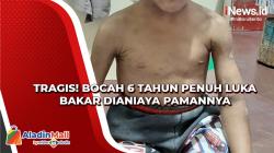 Miris, Bocah 6 Tahun Tubuhnya Penuh Luka Bakar Dianiaya Pamannya di Sikka