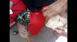 Paman Aniaya Keponakan di Sikka, Jari Korban Luka Bakar Akibat Dihantam Besi Panas