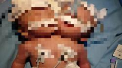 Bayi Kembar Siam 2 Kepala Satu Badan Terlahir di Padang Pariaman, Begini Kondisinya