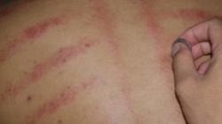 7 Kebiasaan Orang Indonesia yang Dianggap Aneh Orang Bule, Kerokan hingga Makan Mi Pakai Nasi