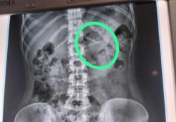 Waduh, Hendak Pakai Jilbab Seorang Remaja di Playen Telan Jarum Pentul