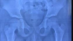 Dokter di China Terkejut Ada Jarum 8 Cm di Penis Bocah 11 Tahun