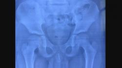 Ngilu! Ada Jarum 8 Cm di Penis Bocah 11 Tahun, kok Bisa?