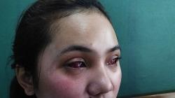 Pemkab Malang Siapkan Pengobatan Mata Gratis bagi Korban Tragedi Kanjuruhan