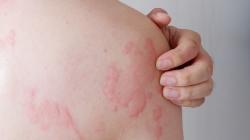 Cara Menghilangkan Biduran secara Alami