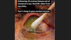Merinding! Dokter Ini Berhasil Keluarkan 23 Lensa Kontak dari Mata Pasien